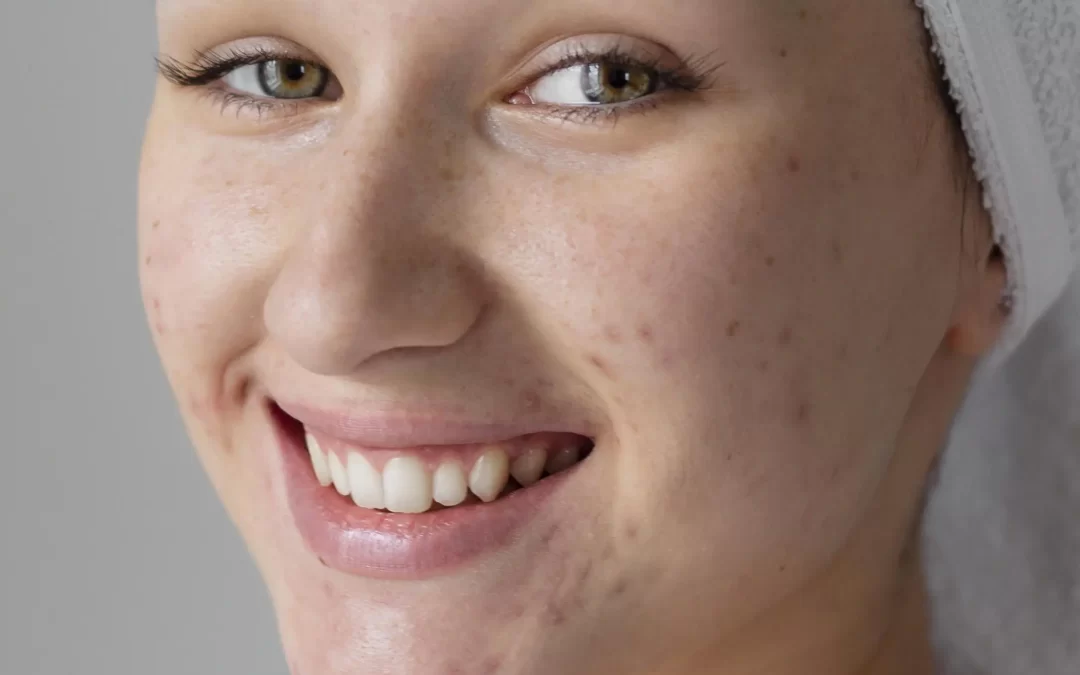 Como Diminuir Cicatrizes da Acne com Tratamentos Seguros