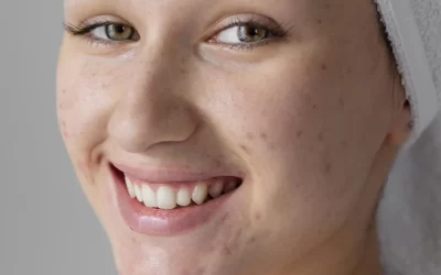 Como Diminuir Cicatrizes da Acne com Tratamentos Seguros