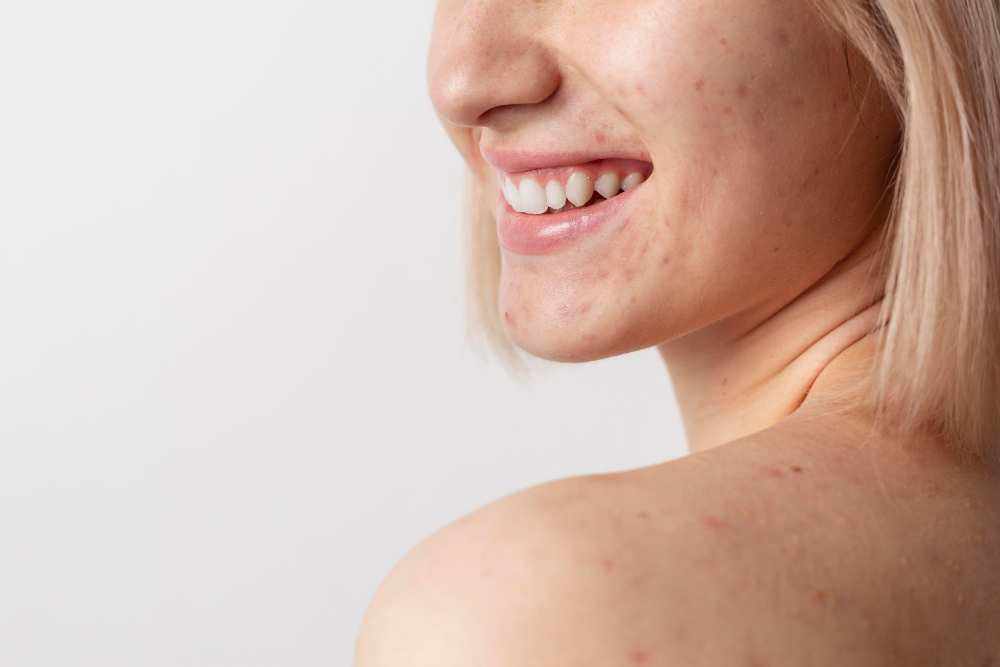 Por que a acne adulta está cada vez mais comum?